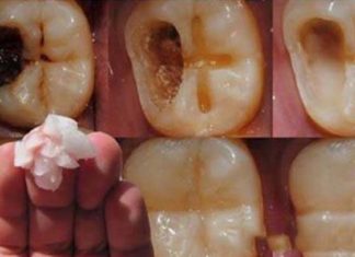 caries